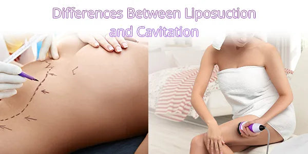 Différences entre la liposuccion et la cavitation